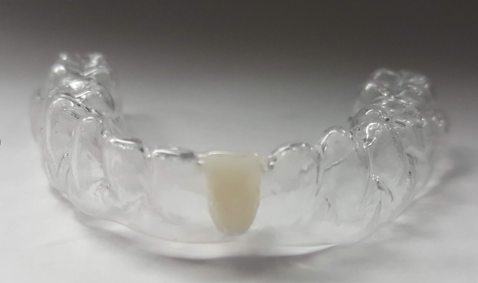 Essix Retainer with Pontic