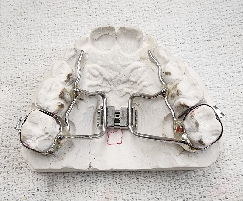 Rapid Palatal Expander (RPE)